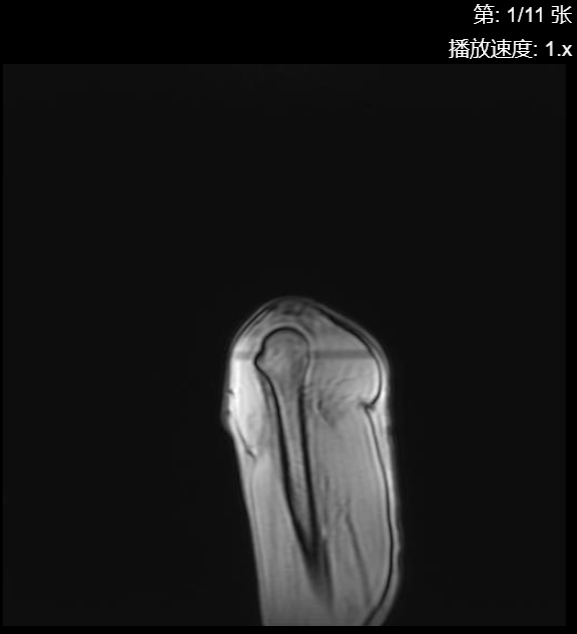 肩袖损伤CT - 扫描组11 切片1