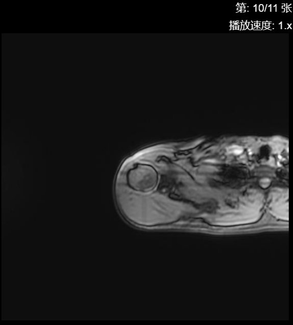 肩袖损伤CT - 扫描组11 切片10