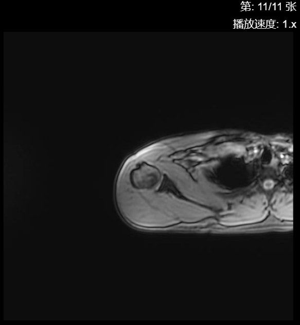 肩袖损伤CT - 扫描组11 切片11