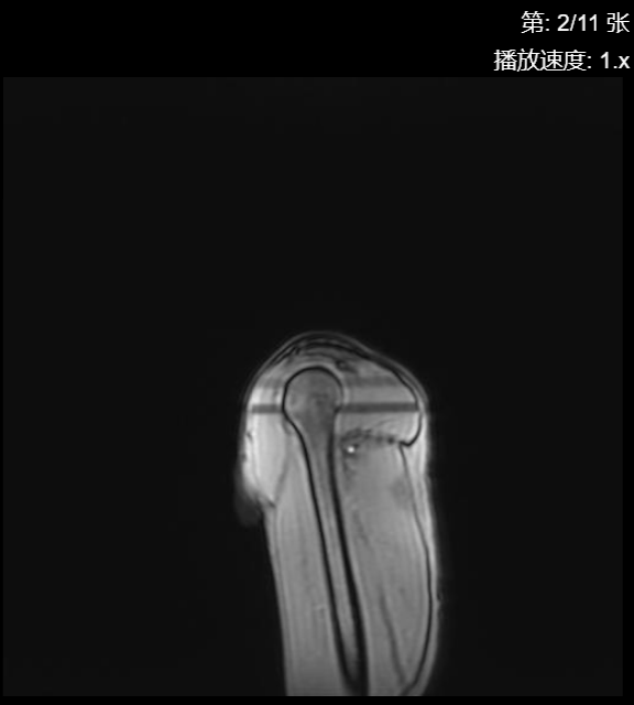 肩袖损伤CT - 扫描组11 切片2