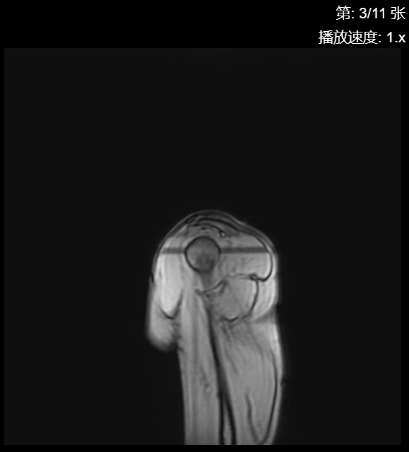肩袖损伤CT - 扫描组11 切片3