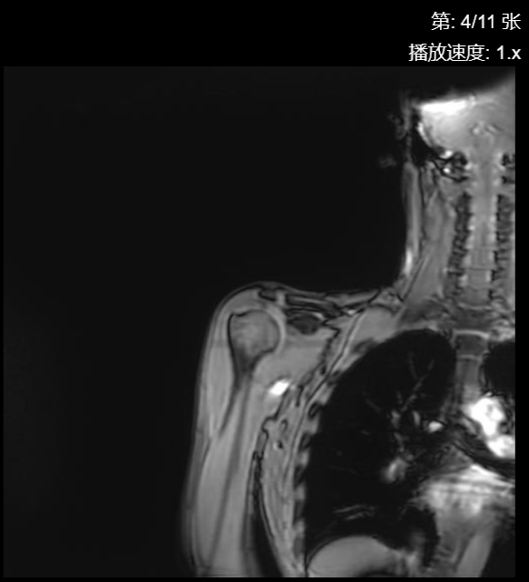 肩袖损伤CT - 扫描组11 切片4