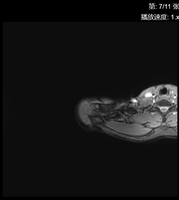 肩袖损伤CT - 扫描组11 切片7