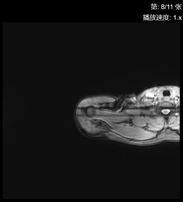 肩袖损伤CT - 扫描组11 切片8