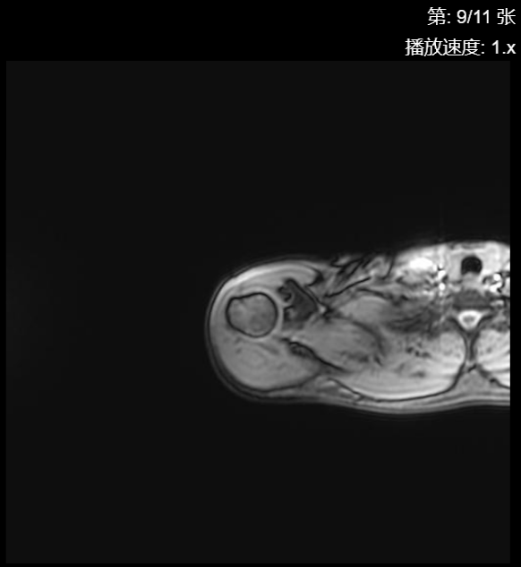 肩袖损伤CT - 扫描组11 切片9